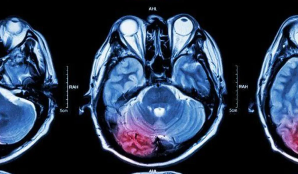 Un simple análisis de sangre podría detectar tumores cerebrales con alta precisión