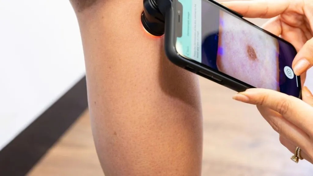 Detección de cáncer de piel con inteligencia artificial desde un smartphone.