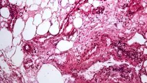 Cáncer renal modifica células grasas cercanas y podría favorecer la progresión del tumor